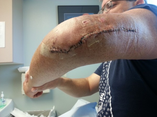 broken arm humorous suture staples cut