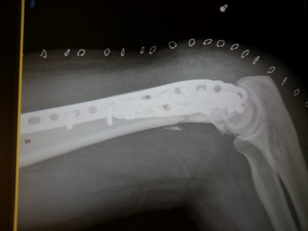 broken arm humerus screws titanium plate
