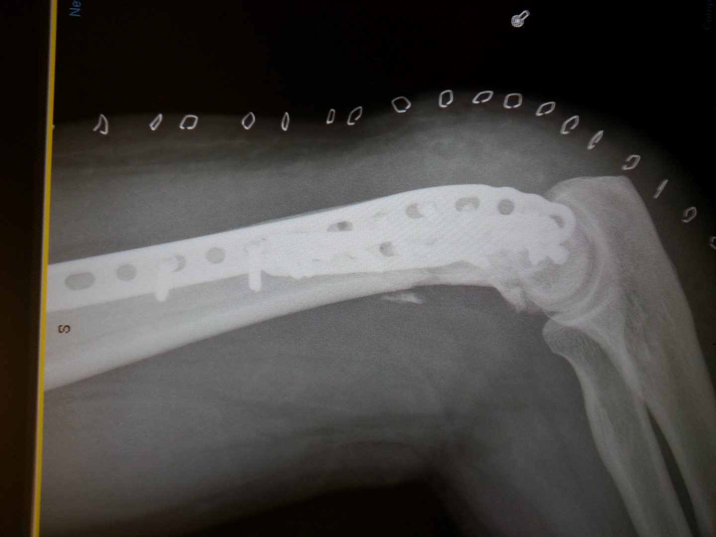 broken arm humorous screws titanium plate