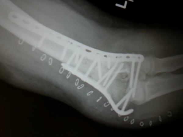 broken arm humerus screws titanium plate