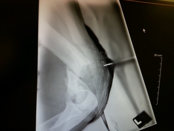 Broken arm humerus compound fracture