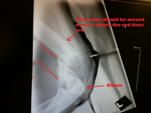 comminuted open fracture pictures