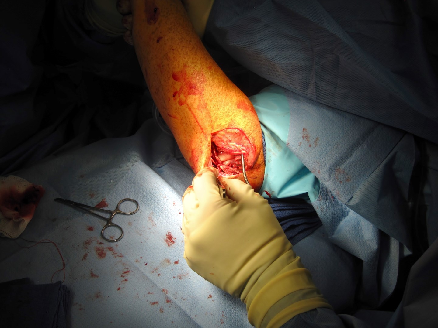 arm surgery 3 elbow humerus tendon reconstruction